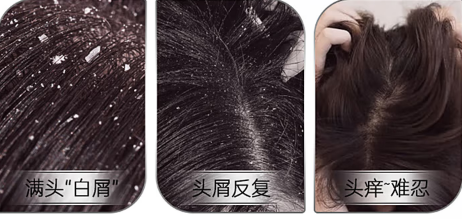 小米手机哪款好:去屑止痒哪款洗发水好?